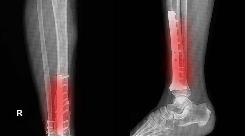 Studie Om Skenbensfrakturer Blev Missräkning För Bonesupport